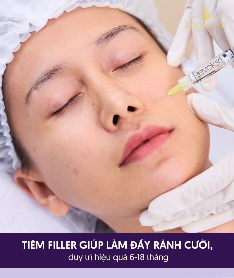 Tiêm ha làm đầy rãnh cười