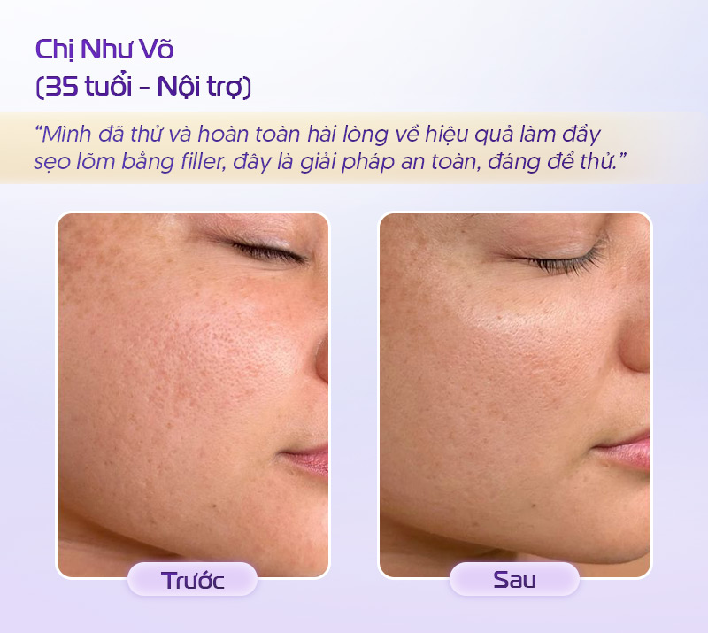 Tiêm làm đầy sẹo lõm