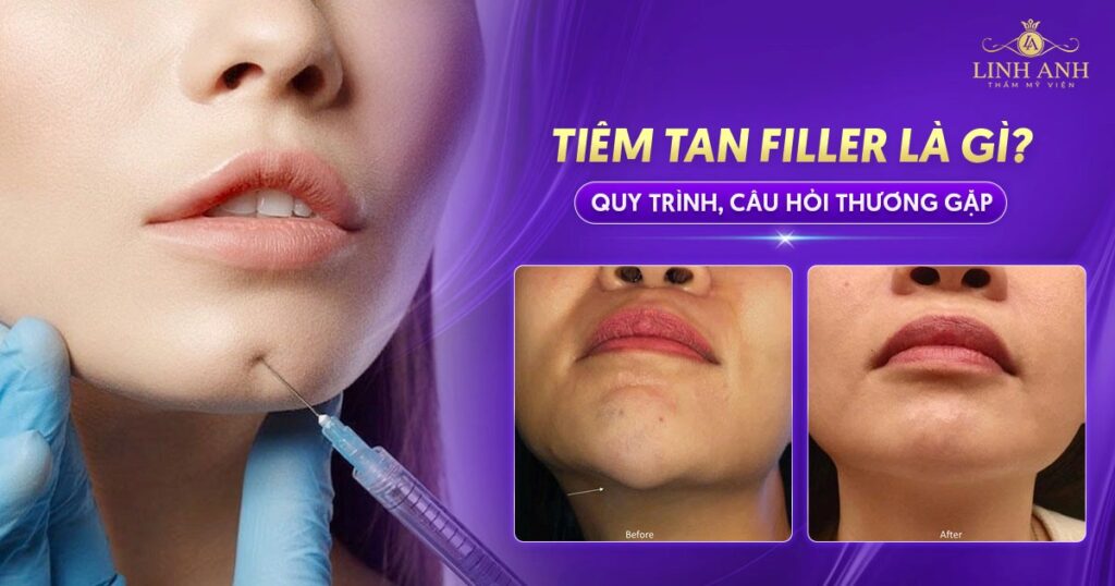 Tiêm tan filler