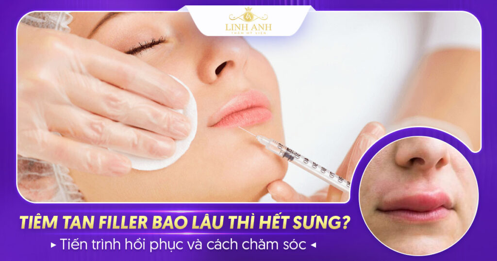 Tiêm tan filler bao lâu thì hết sưng