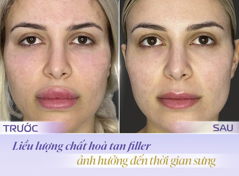 Tiêm tan filler bị sưng phải làm sao