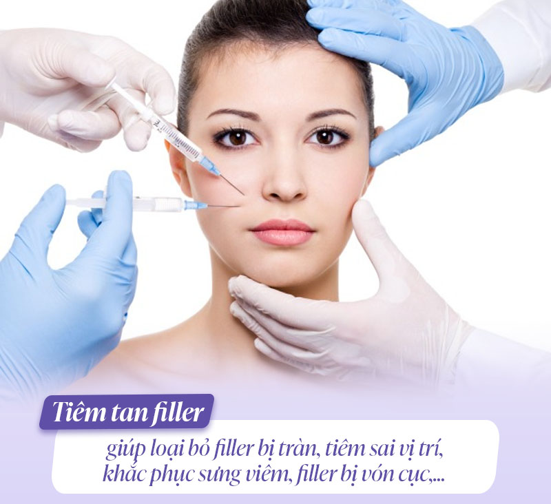 Tiêm tan filler là gì