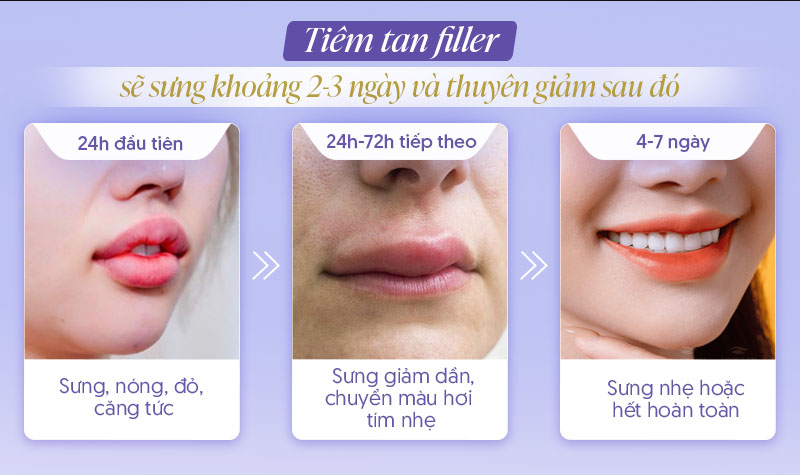 Tiêm tan filler mấy ngày thì hết sưng