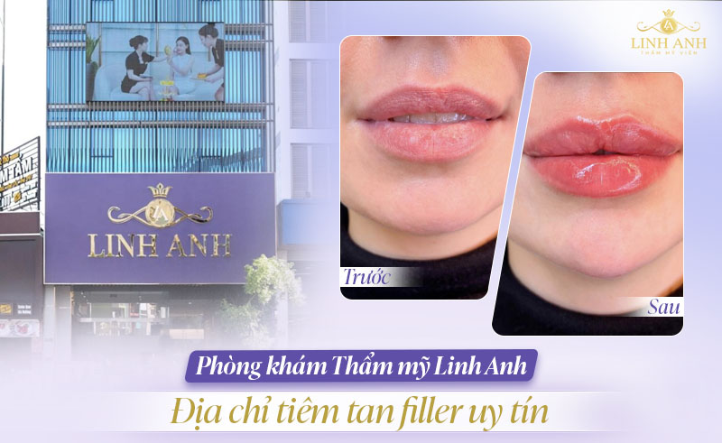 Tiêm tan filler ở đâu