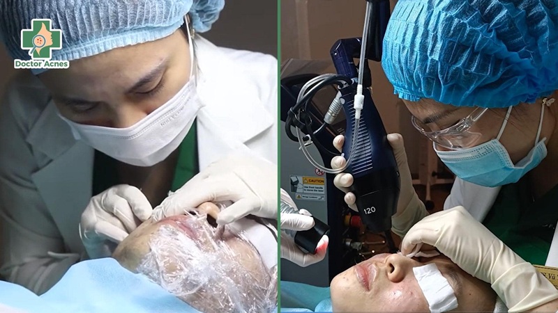 trị sẹo rỗ ở Phòng khám Da liễu Doctor Acnes