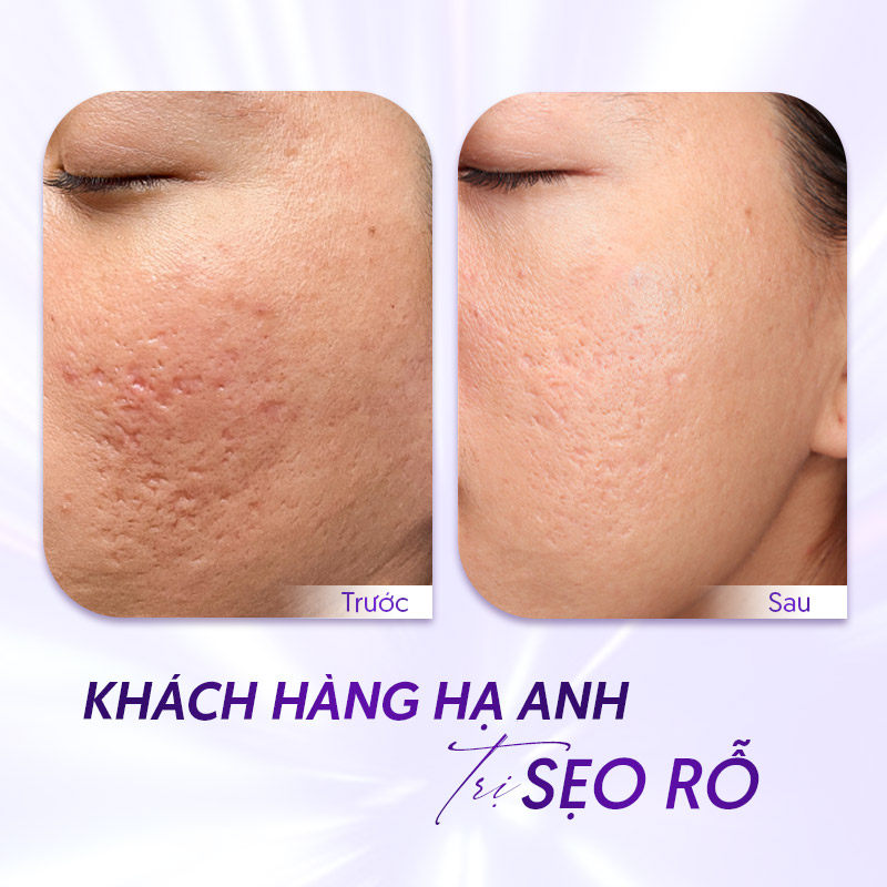 trị sẹo rỗ ở đâu hiệu quả