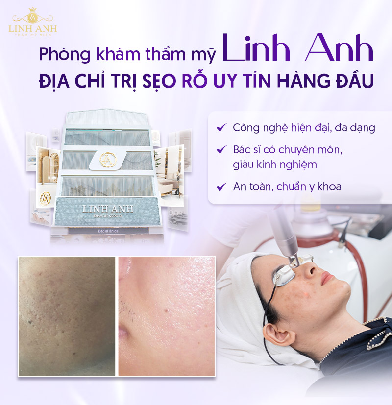 trị sẹo rỗ ở đâu