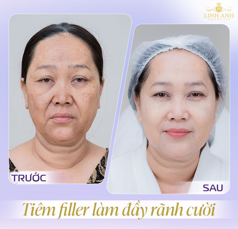 trước và sau tiêm rãnh cười