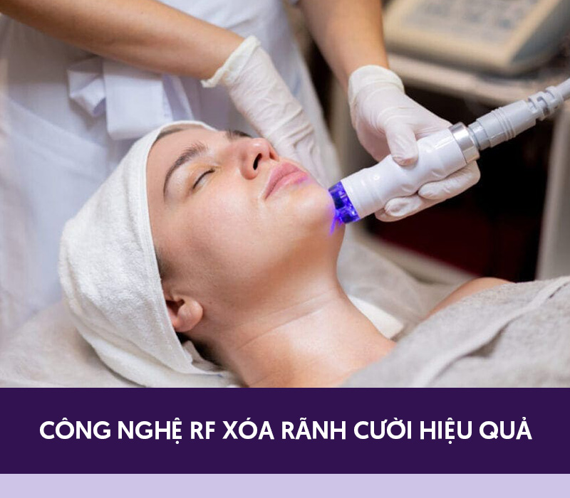 Xóa rãnh cười bằng công nghệ RF