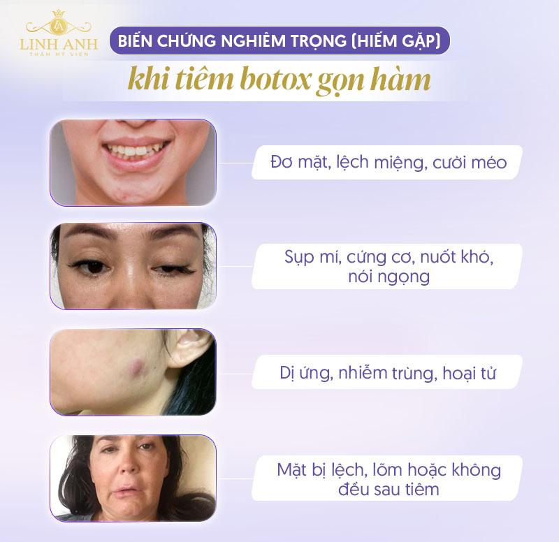 Biến chứng khi tiêm botox gọn hàm