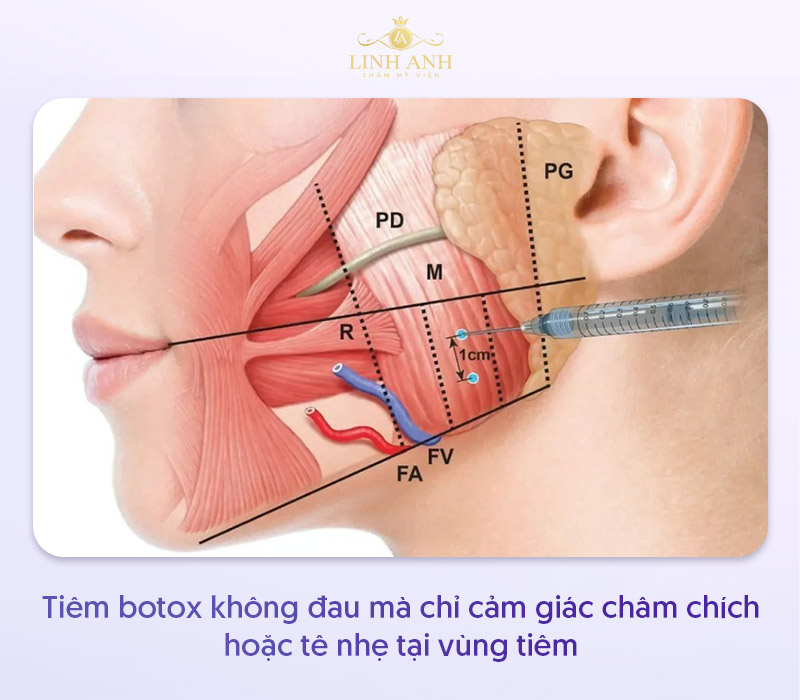 Botox thon gọn hàm có đau không