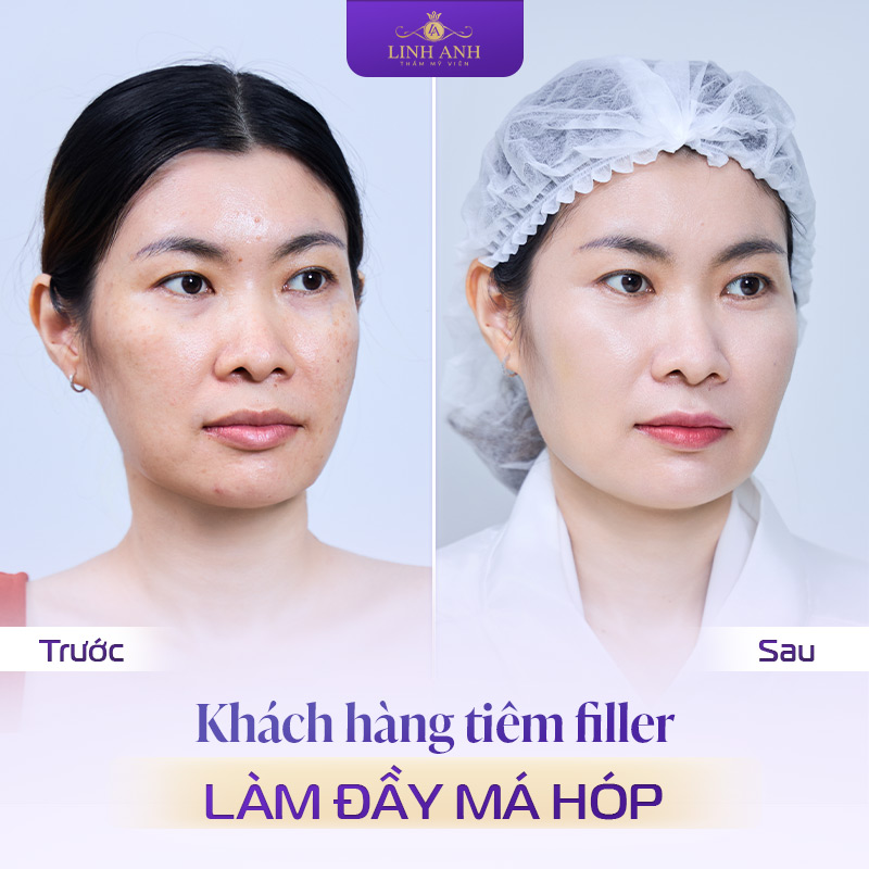 Cách làm đầy má hóp nhanh chóng chuẩn y khoa