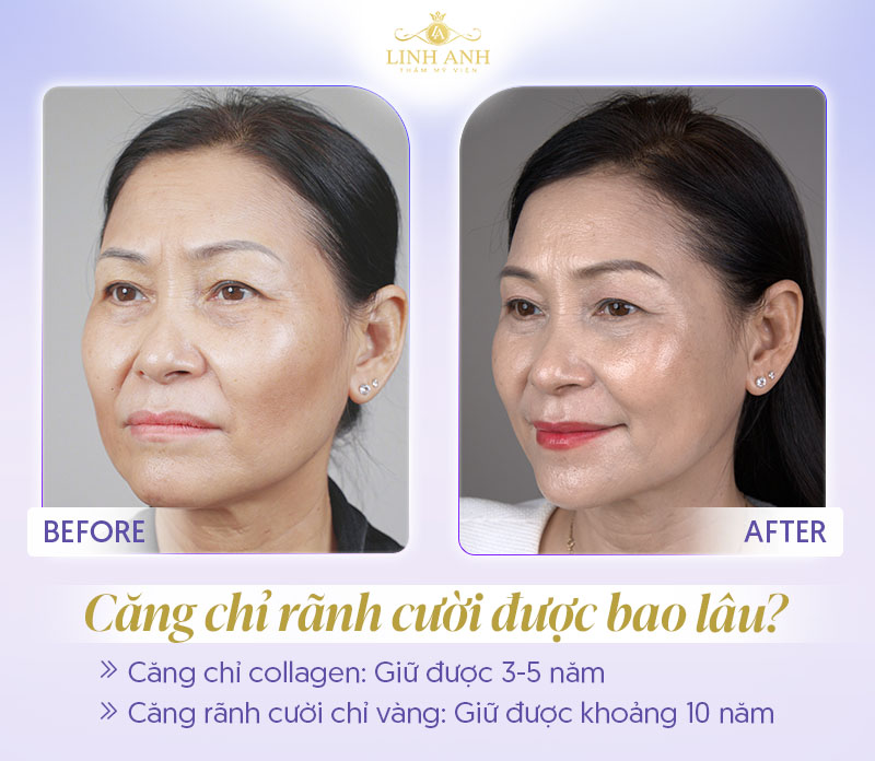 Căng chỉ rãnh cười được bao lâu