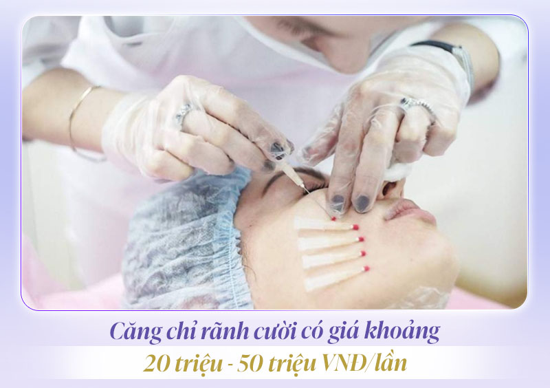 Căng chỉ rãnh cười giá bao nhiêu
