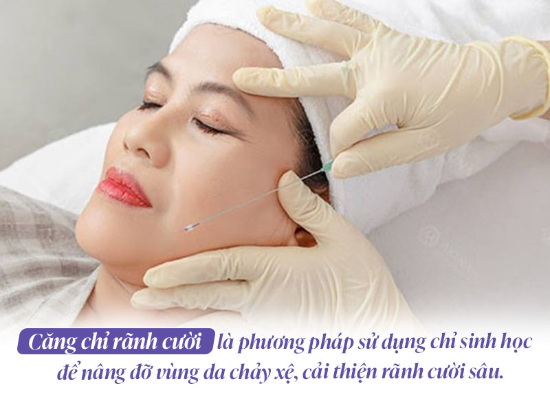 Căng chỉ rãnh cười là gì