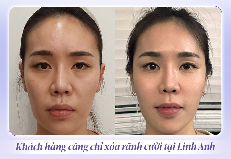 cang chi ranh cuoi tai linh anh