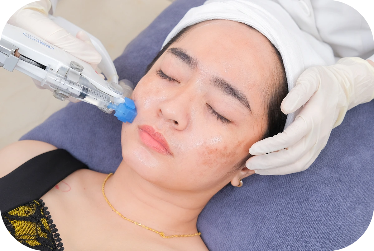 Dịch vụ điều trị nám