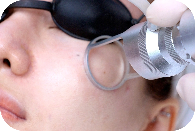 Dịch vụ điều trị sẹo