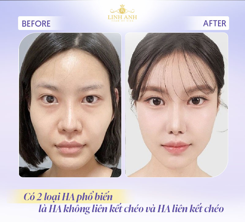 Có mấy loại HA tiêm