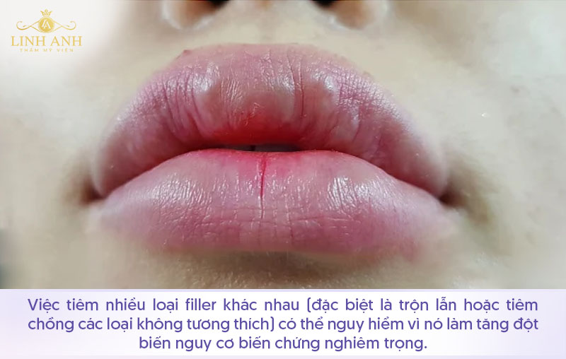 Có nên tiêm 2 loại filler khác nhau
