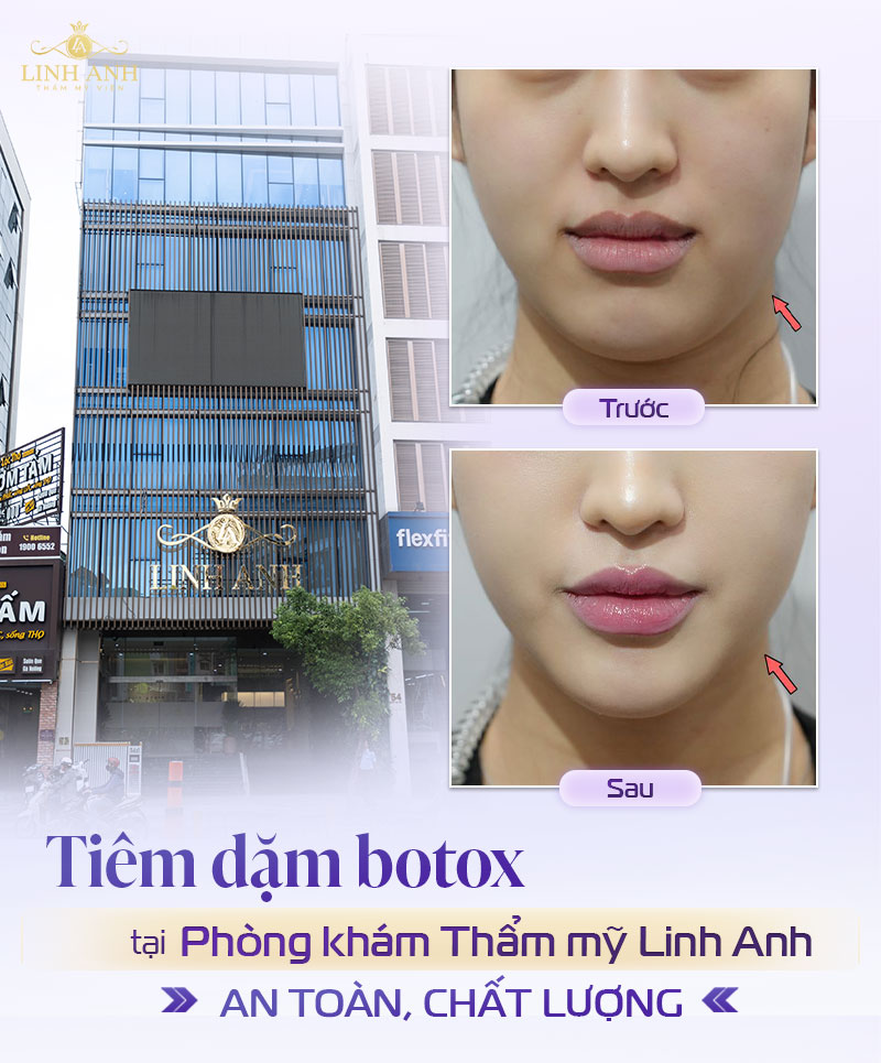 Địa chỉ tiêm botox thon hàm tphcm Địa chỉ tiêm botox thon hàm tphcm