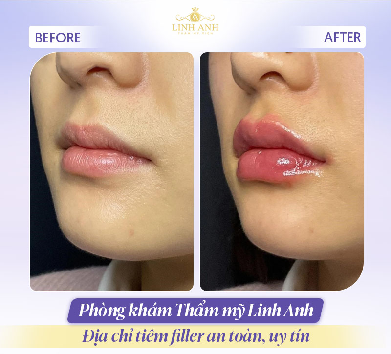 Địa chỉ tiêm filler an toàn tại TPHCM