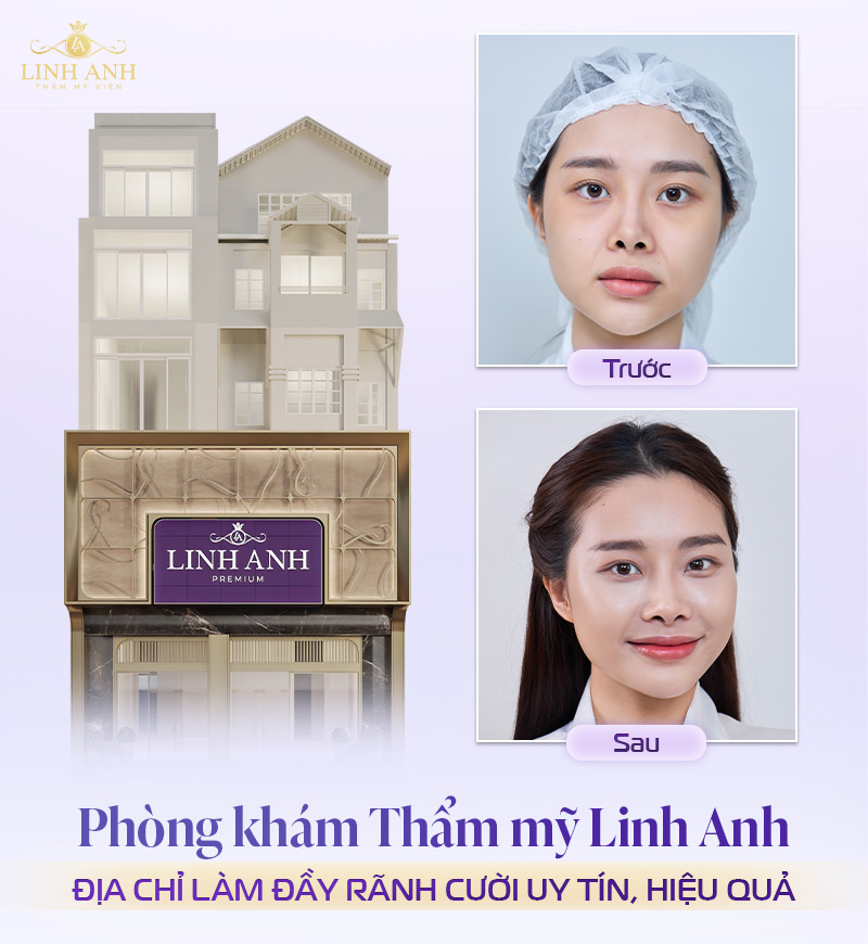 Địa chỉ tiêm rãnh cười uy tín tại TPHCM