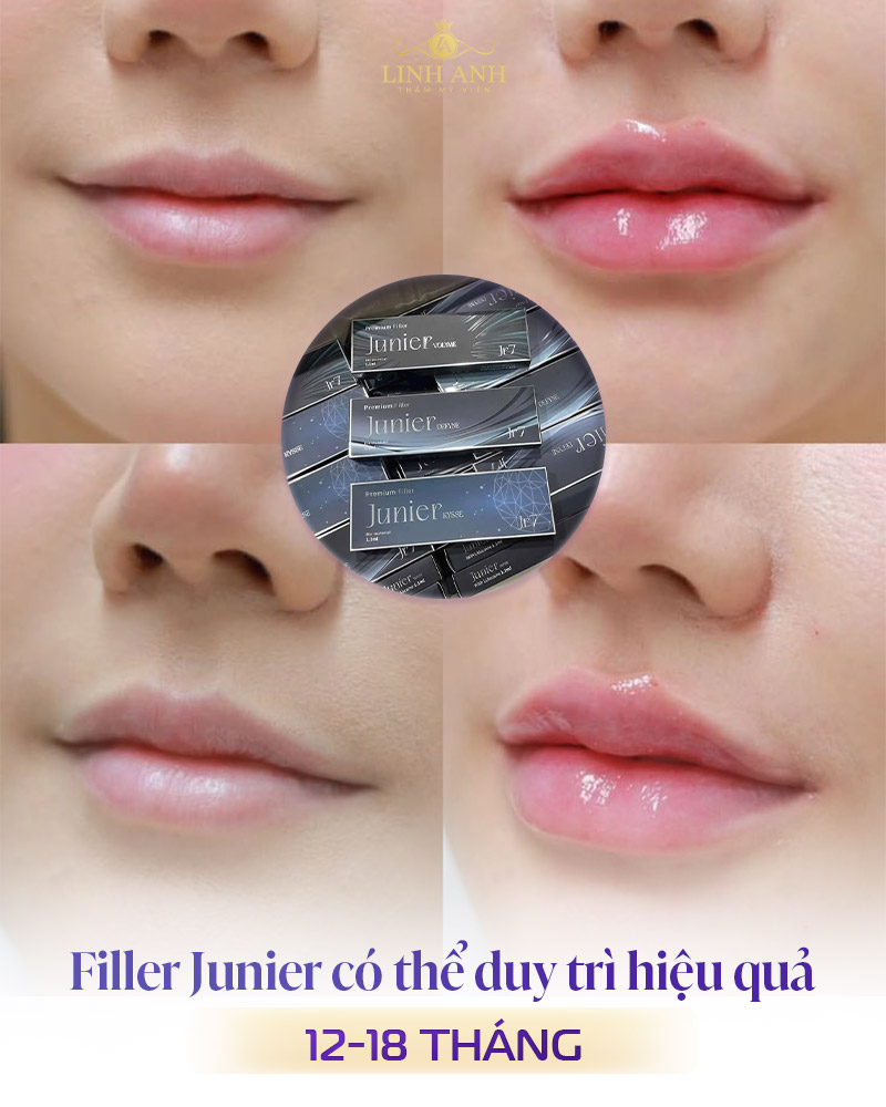 Filler Junier giữ được bao lâu