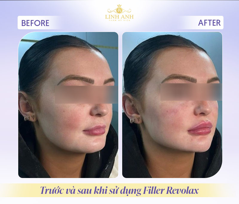 Filler Revolax giá bao nhiêu