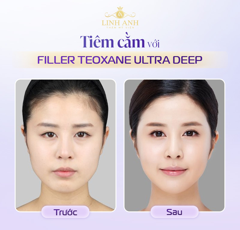 Filler Teoxane tiêm cằm