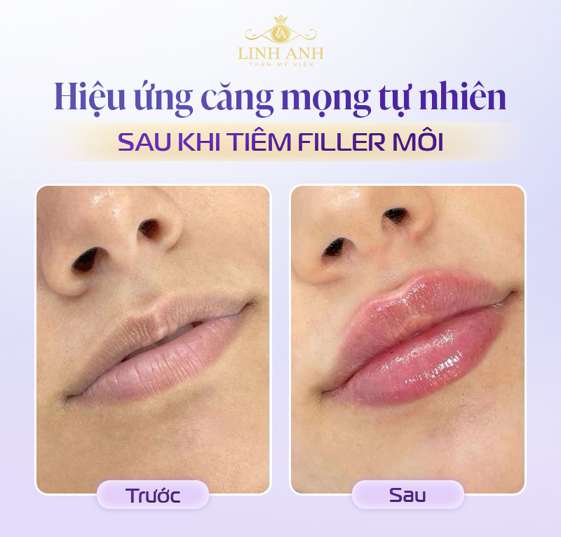 Filler Teoxane tiêm môi Filler Teoxane tiêm môi