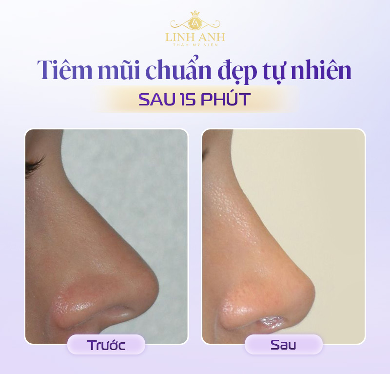 Filler Teoxane tiêm mũi