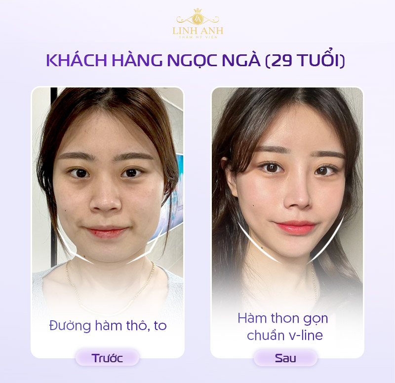 Hình ảnh tiêm botox thon gọn hàm