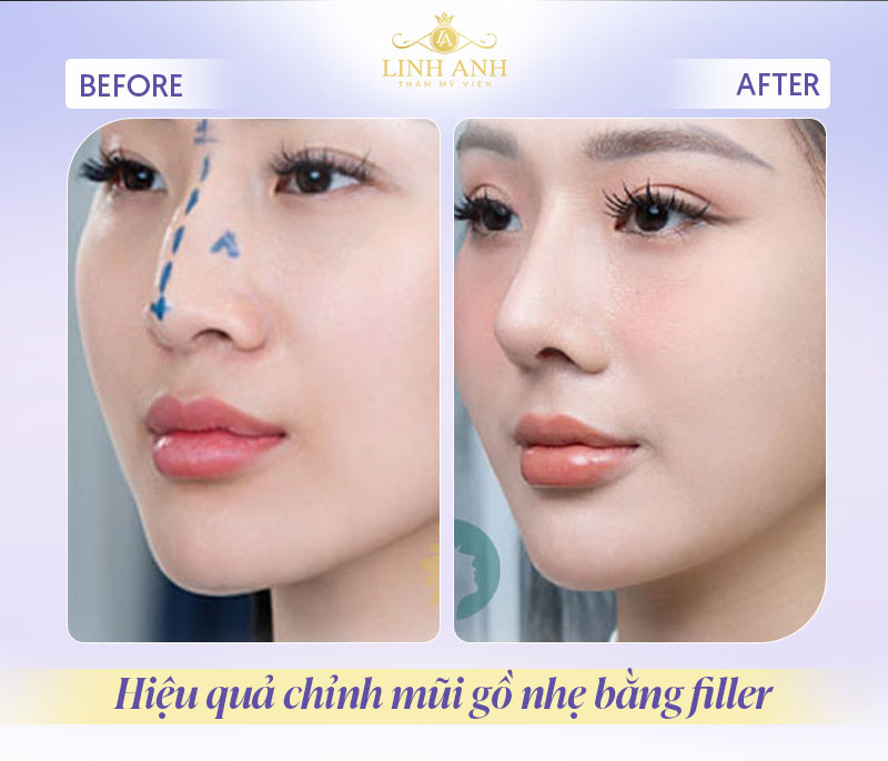 Hình ảnh trước và sau Tiêm filler mũi Hình ảnh trước và sau Tiêm filler mũi