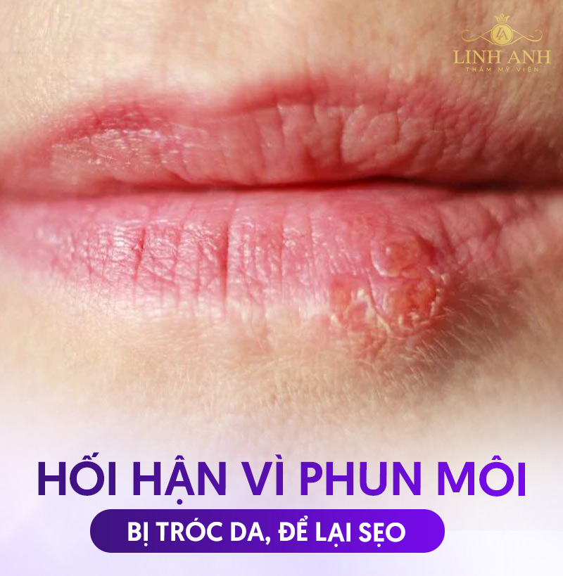 hối hận vì phun môi ở cơ sở kém uy tín hối hận vì phun môi ở cơ sở kém uy tín