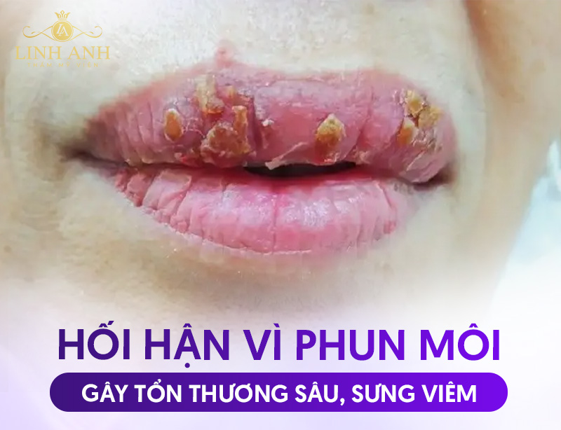 hối hận vì phun môi ở tmv chui hối hận vì phun môi ở tmv chui