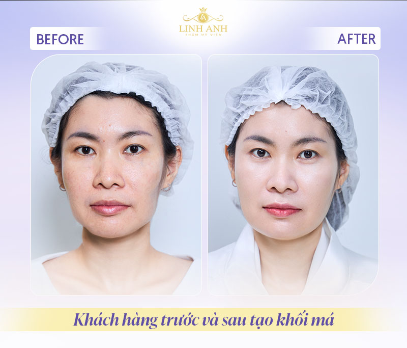 Làm đầy má bằng filler