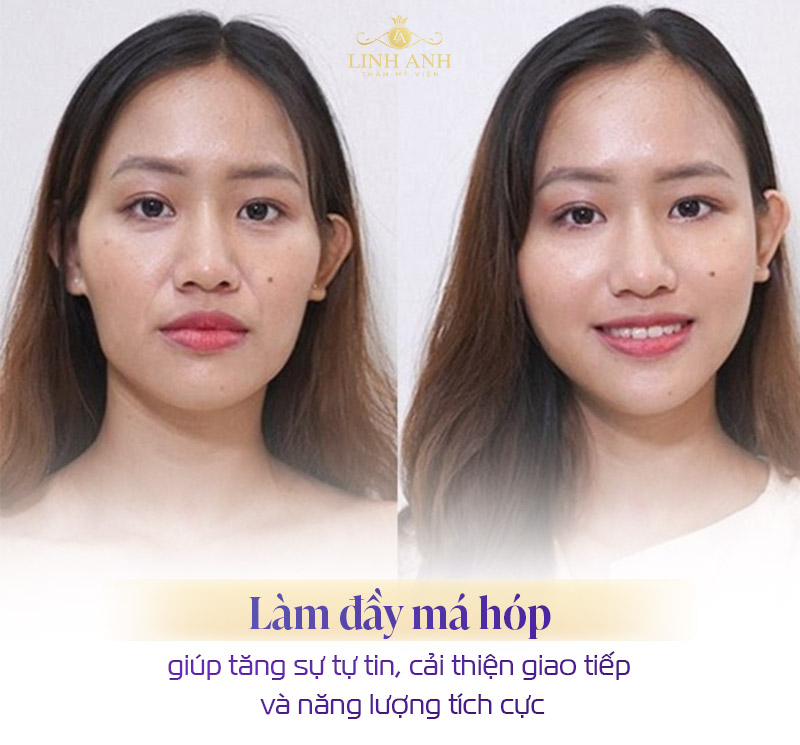 Làm đầy má hóp có thay đổi tướng số không Làm đầy má hóp có thay đổi tướng số không