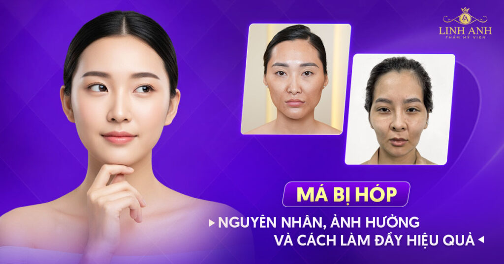 Má bị hóp