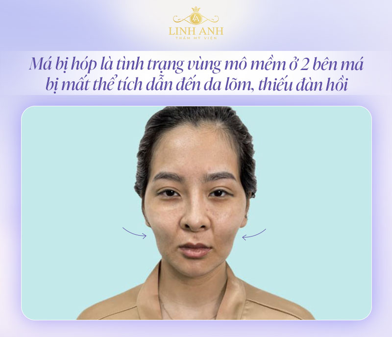 Má bị hóp là gì Má bị hóp là gì