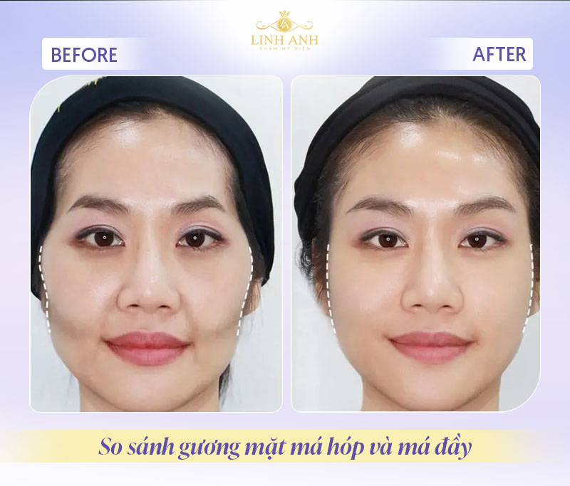 Má hóp trong nhân tướng học Má hóp trong nhân tướng học