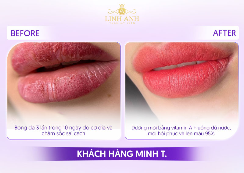 Môi sau phun bị bong da nhiều lầm