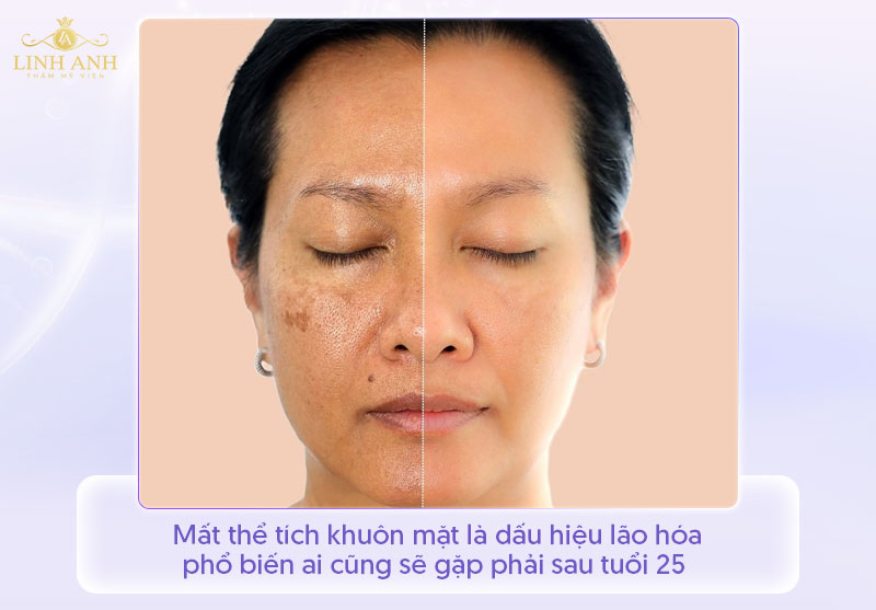 Nên cấy mỡ mặt hay tiêm filler Nên cấy mỡ mặt hay tiêm filler