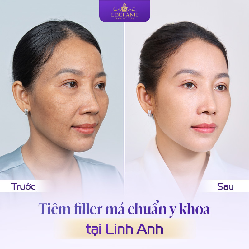 Nên tiêm má baby ở đâu