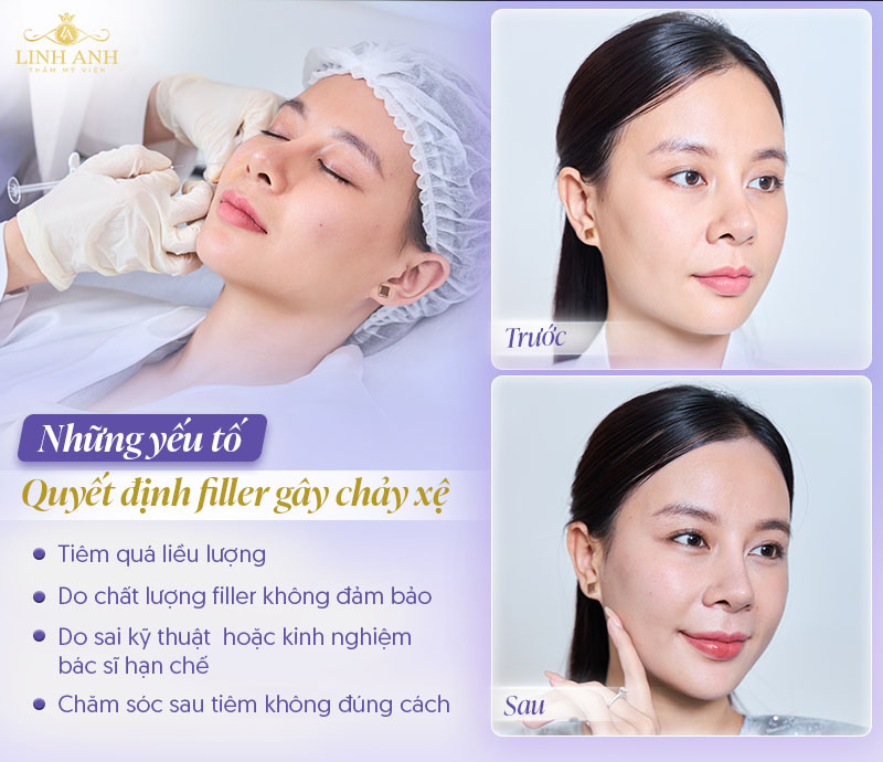 Nguyên nhân tiêm filller bị chảy xệ