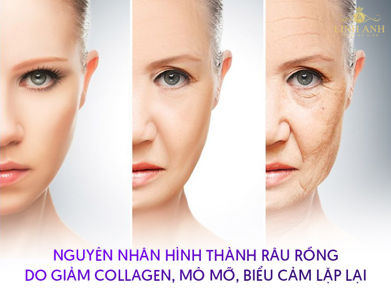 rãnh cười râu rồng rãnh cười râu rồng