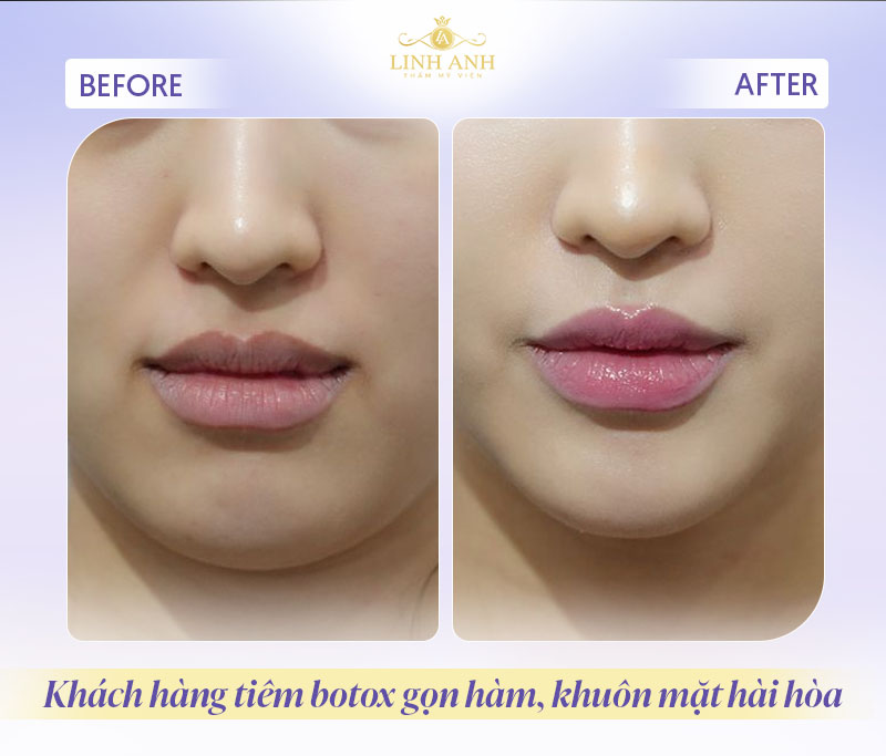 review sau tiêm botox thon gọn hàm