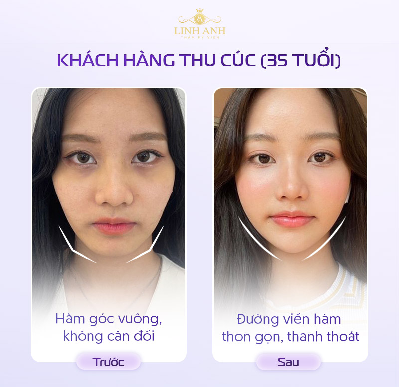 Review tiêm botox gọn hàm