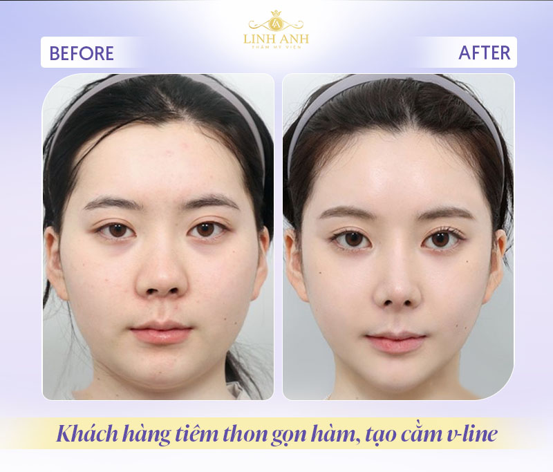 review tiêm botox thon gọn hàm