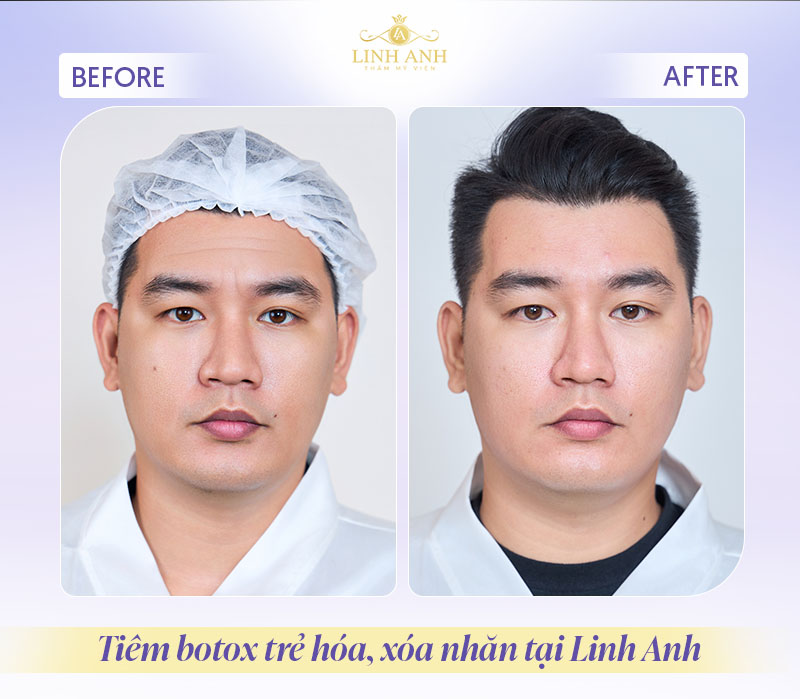 Review tiêm botox trẻ hóa